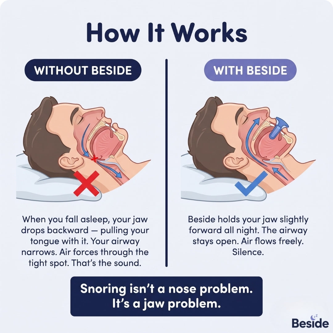 Beside™ Anti-Snoring Mouthpiece